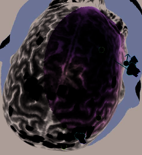 Repetitive Transcranial Magnetic Stimulation image