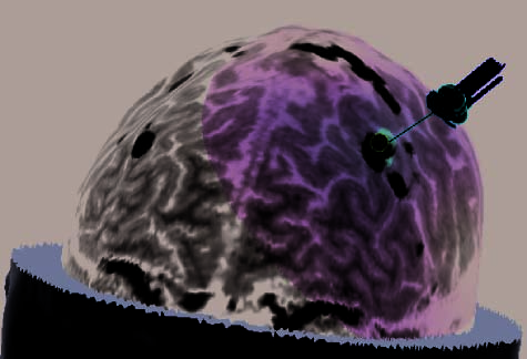 Repetitive Transcranial Magnetic Stimulation image