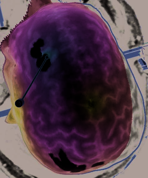 Repetitive Transcranial Magnetic Stimulation image