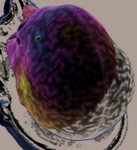 Repetitive Transcranial Magnetic Stimulation image