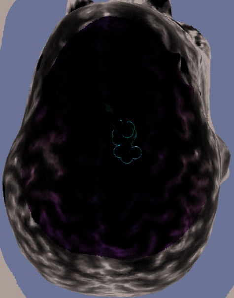 Repetitive Transcranial Magnetic Stimulation image