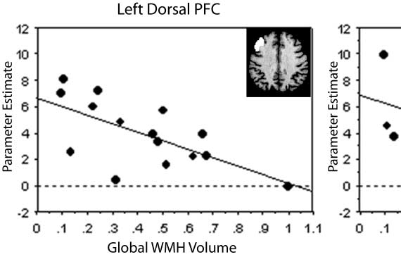 White Matter Changes Compromise Prefrontal Cortex image