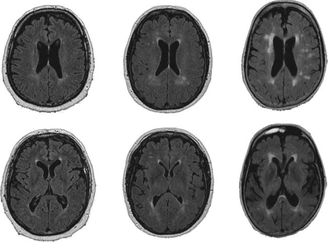 White Matter Changes Compromise Prefrontal Cortex image