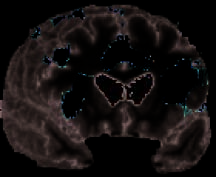 White Matter Changes Compromise Prefrontal Cortex image