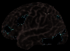 White Matter Changes Compromise Prefrontal Cortex image