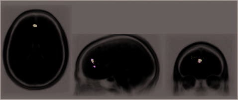 A Brain Mechanism for Facilitation of Insight image