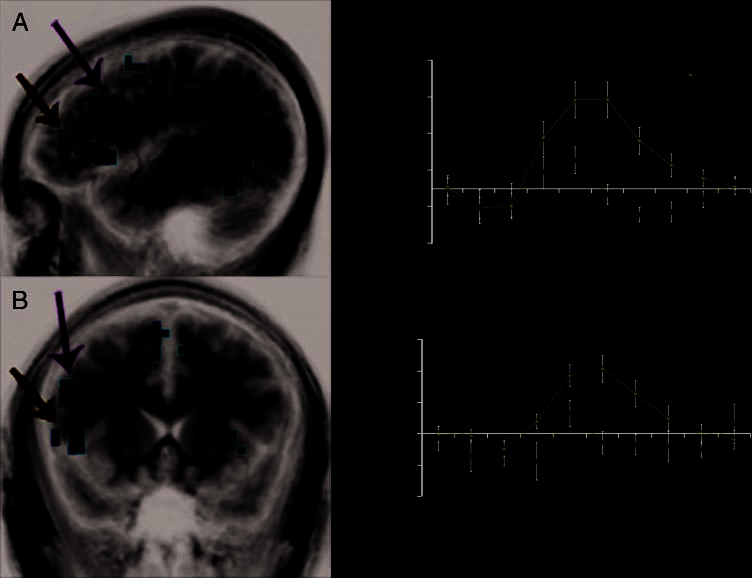 Dissociation of Frontal and Medial Temporal image