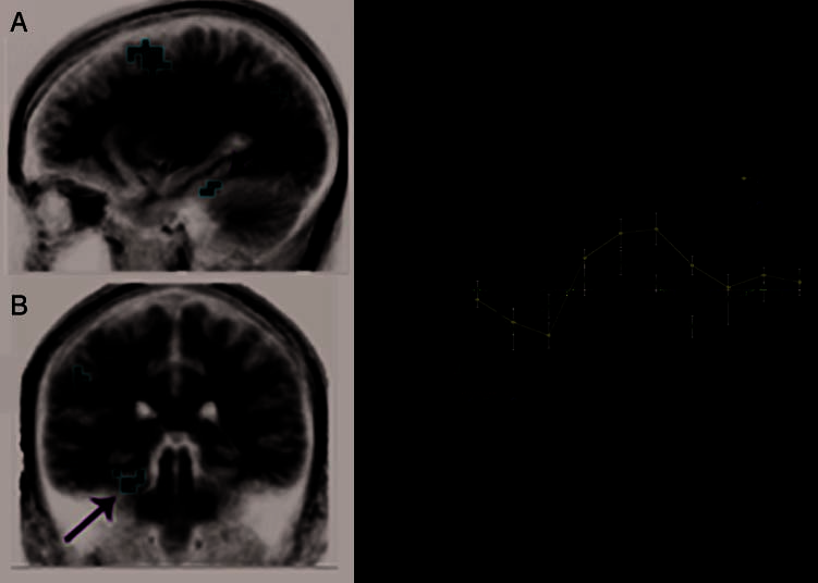 Dissociation of Frontal and Medial Temporal image