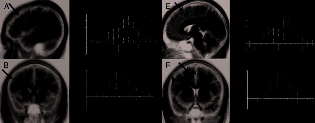 Dissociation of Frontal and Medial Temporal image