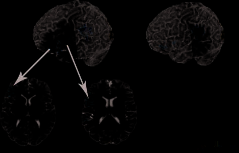 Neural Systems underlying Lexical Competition: Immagine