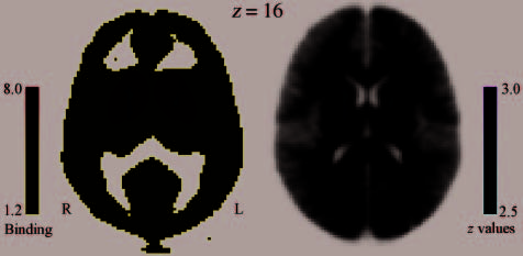 PET Evidence for a Role for Striatal Dopamine in the image