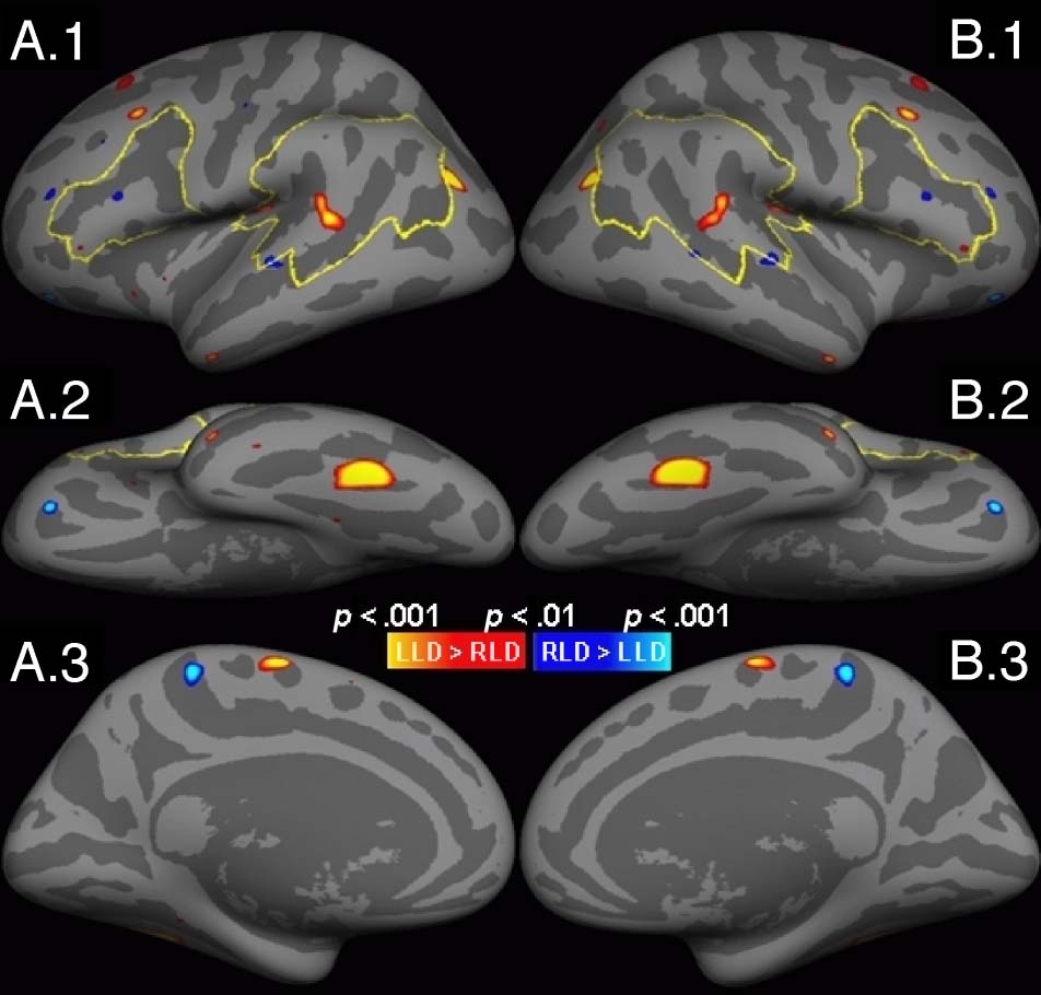 A Surface-based Analysis of Language Lateralization image