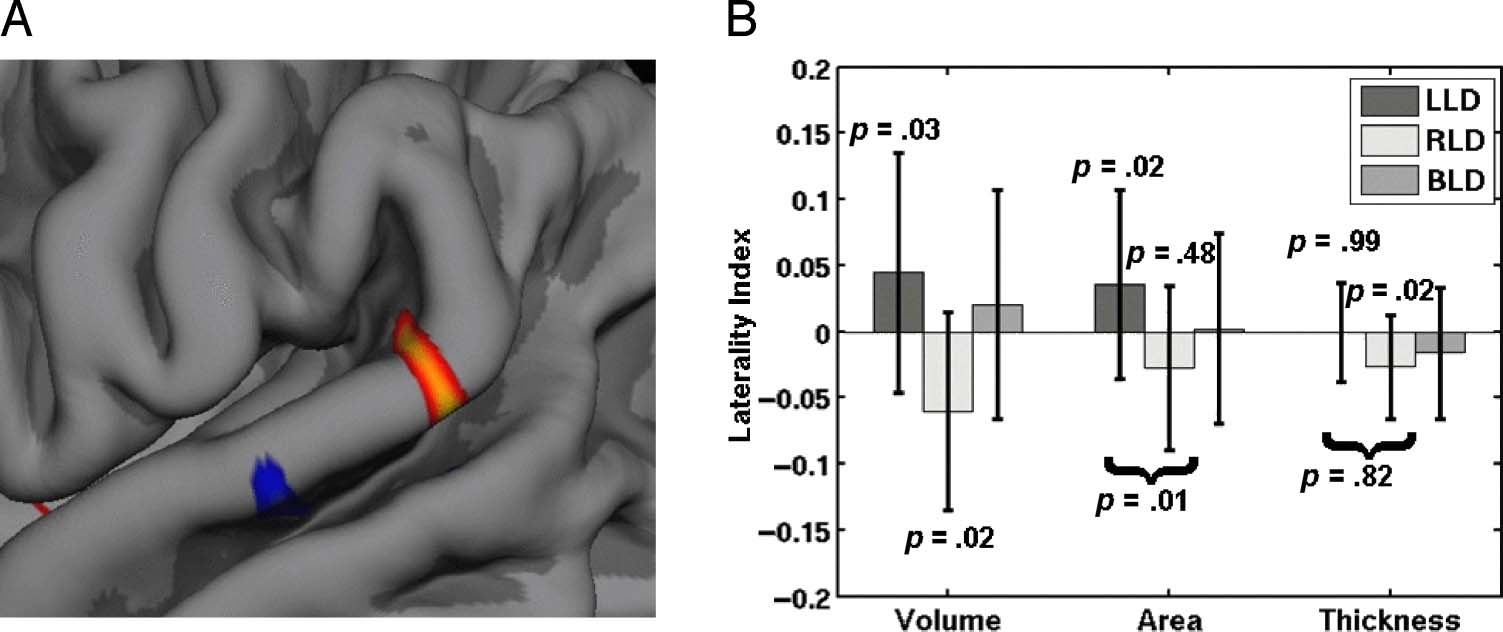 A Surface-based Analysis of Language Lateralization image