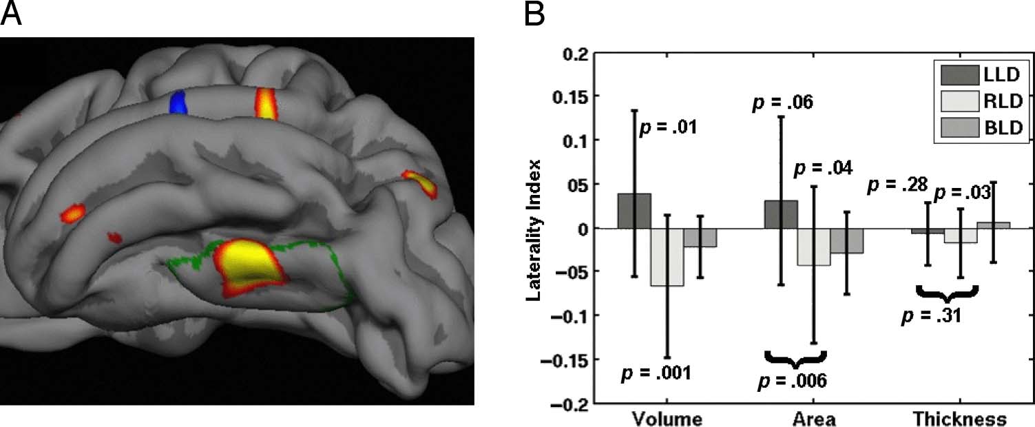 A Surface-based Analysis of Language Lateralization image