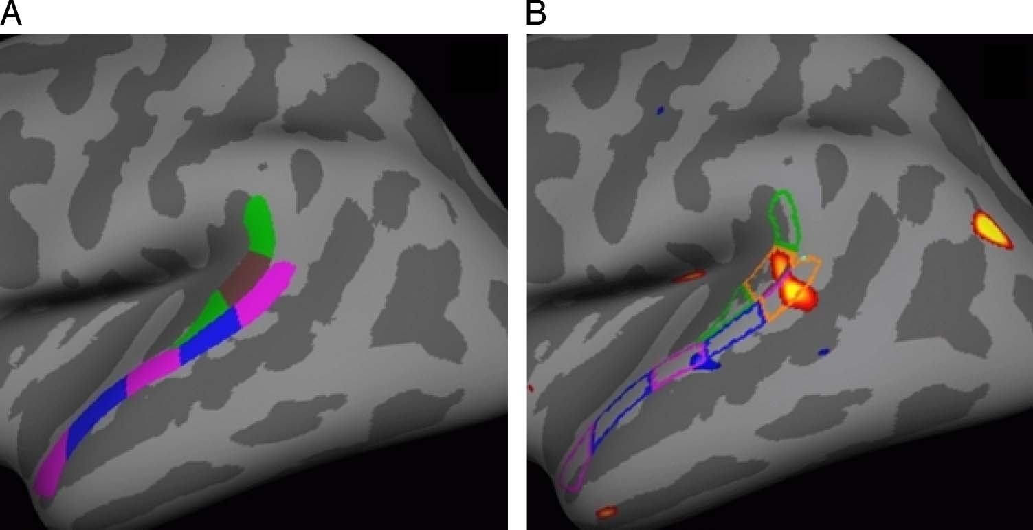 A Surface-based Analysis of Language Lateralization image