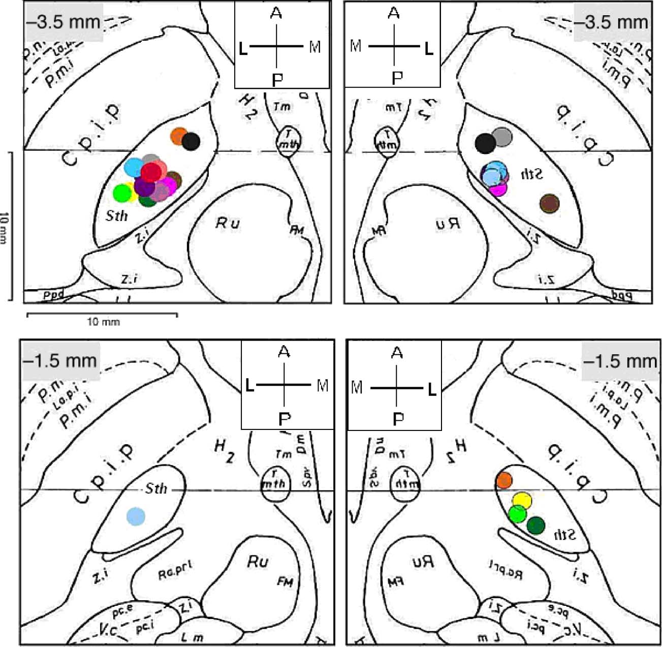 The Subthalamic Nucleus Influences Visuospatial image