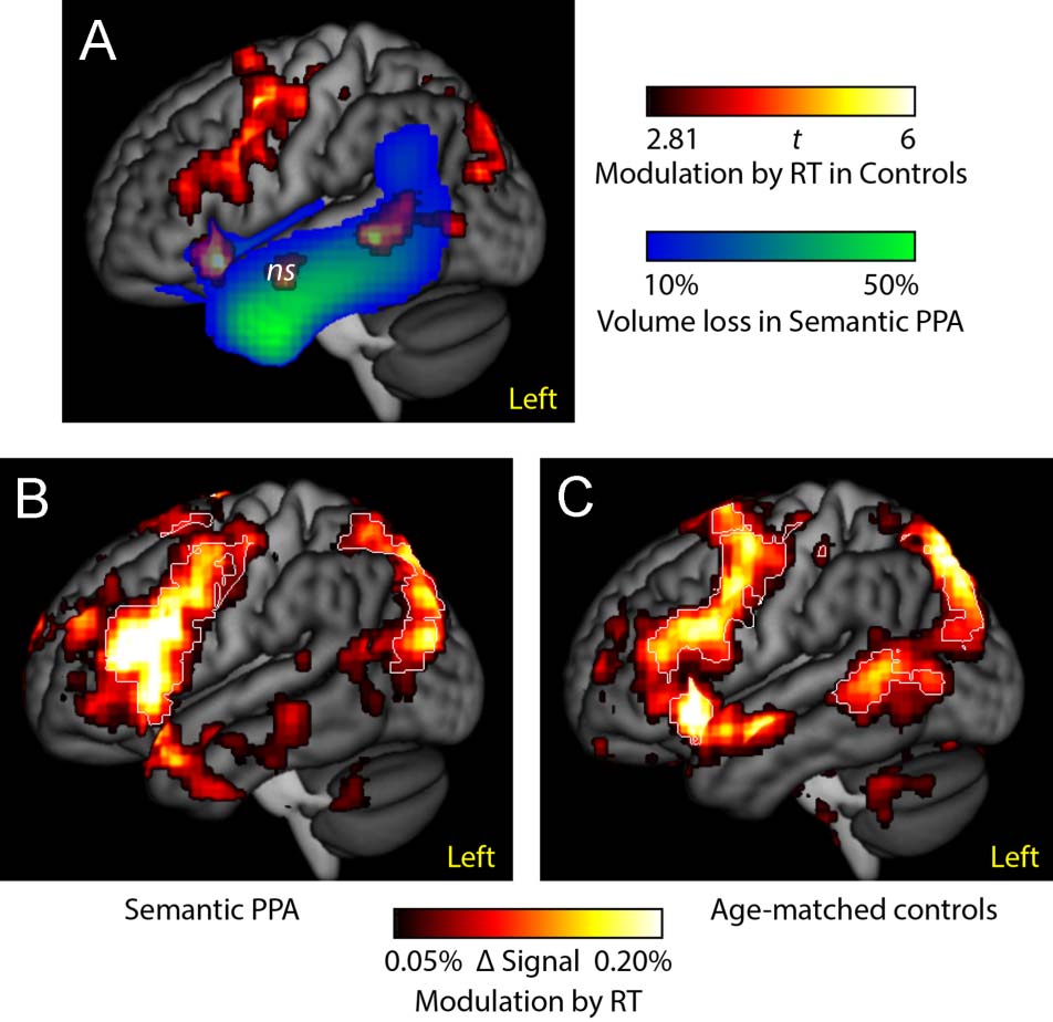 What Role Does the Anterior Temporal Lobe Play image