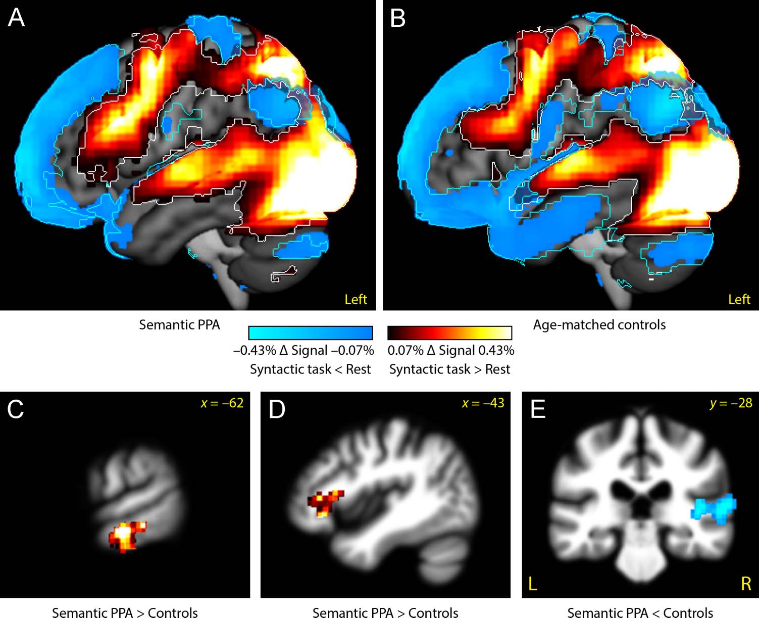 What Role Does the Anterior Temporal Lobe Play image