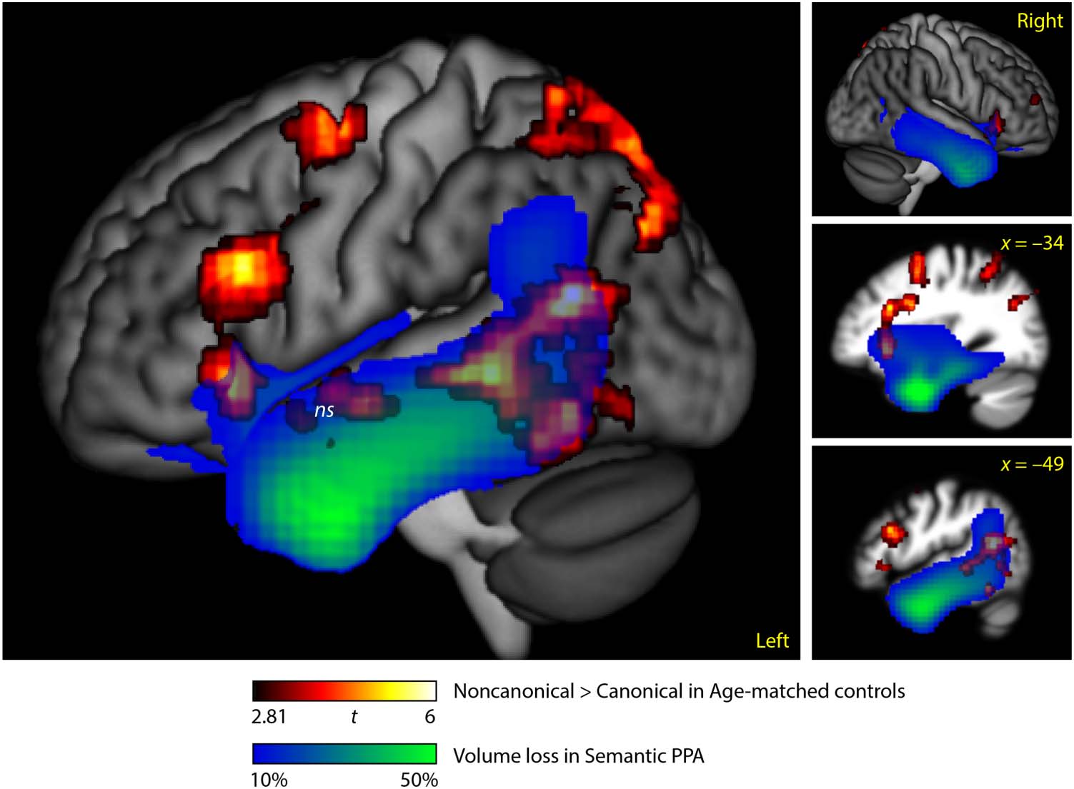 What Role Does the Anterior Temporal Lobe Play image