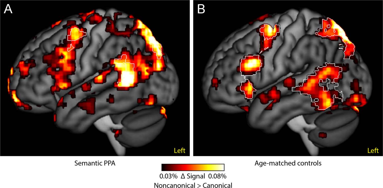 What Role Does the Anterior Temporal Lobe Play image