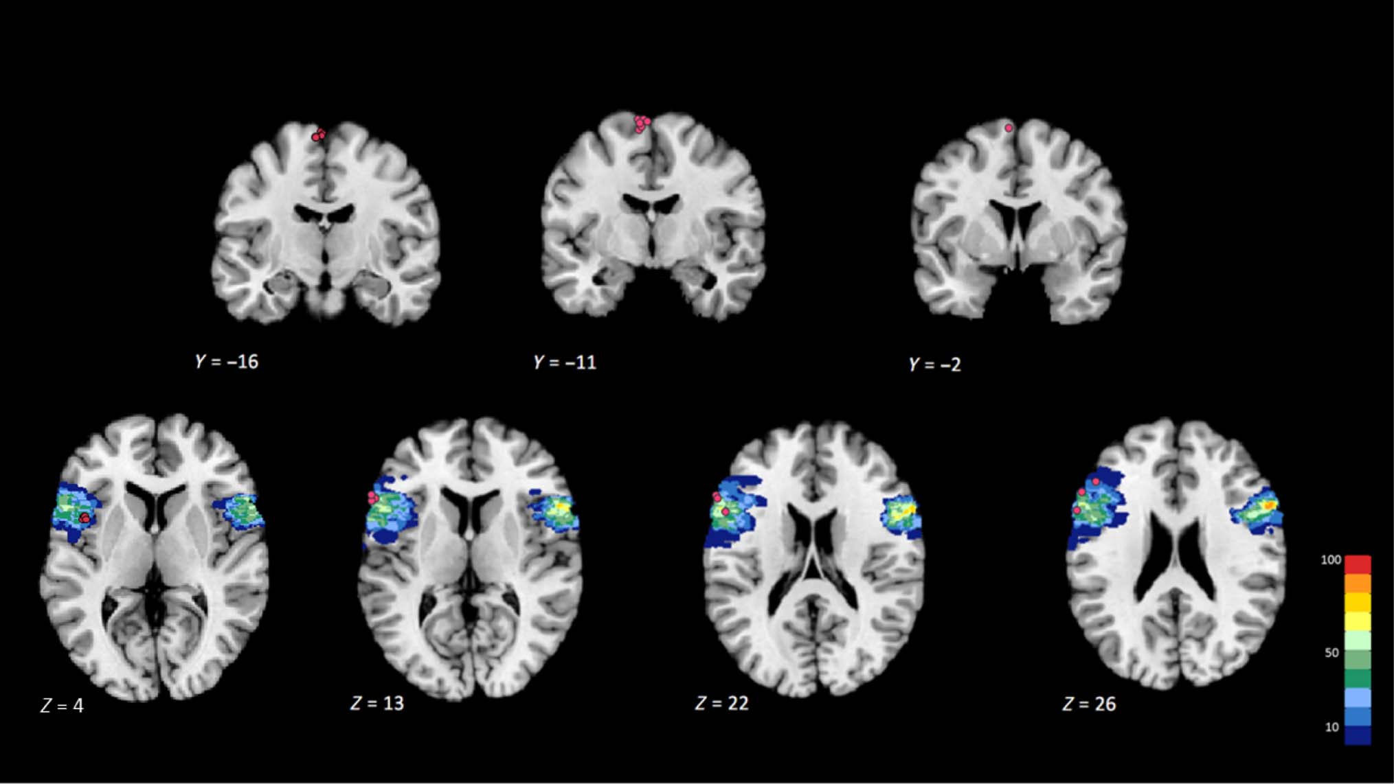 Disruption of Broca’s Area Alters Higher-order Chunking image