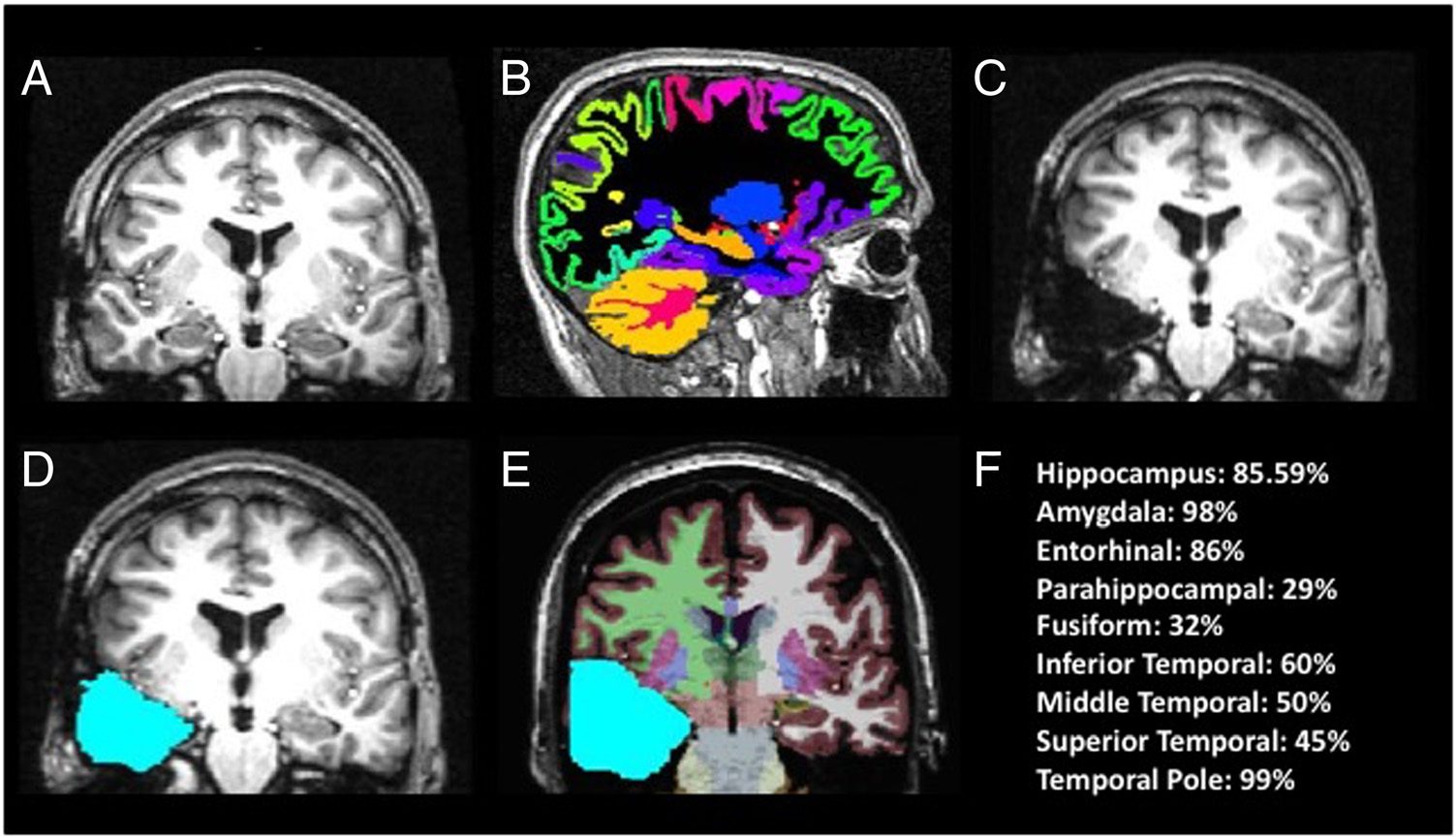 Parahippocampal and Entorhinal Resection Extent image