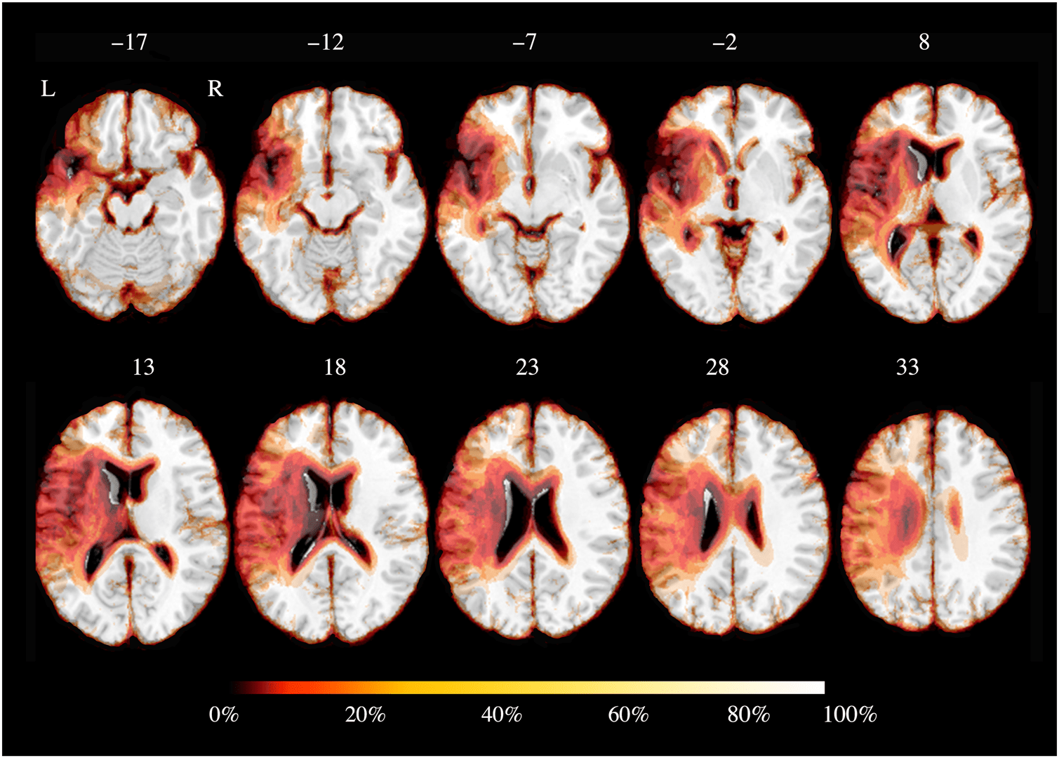 Transcranial Cerebellar Direct Current Stimulation image