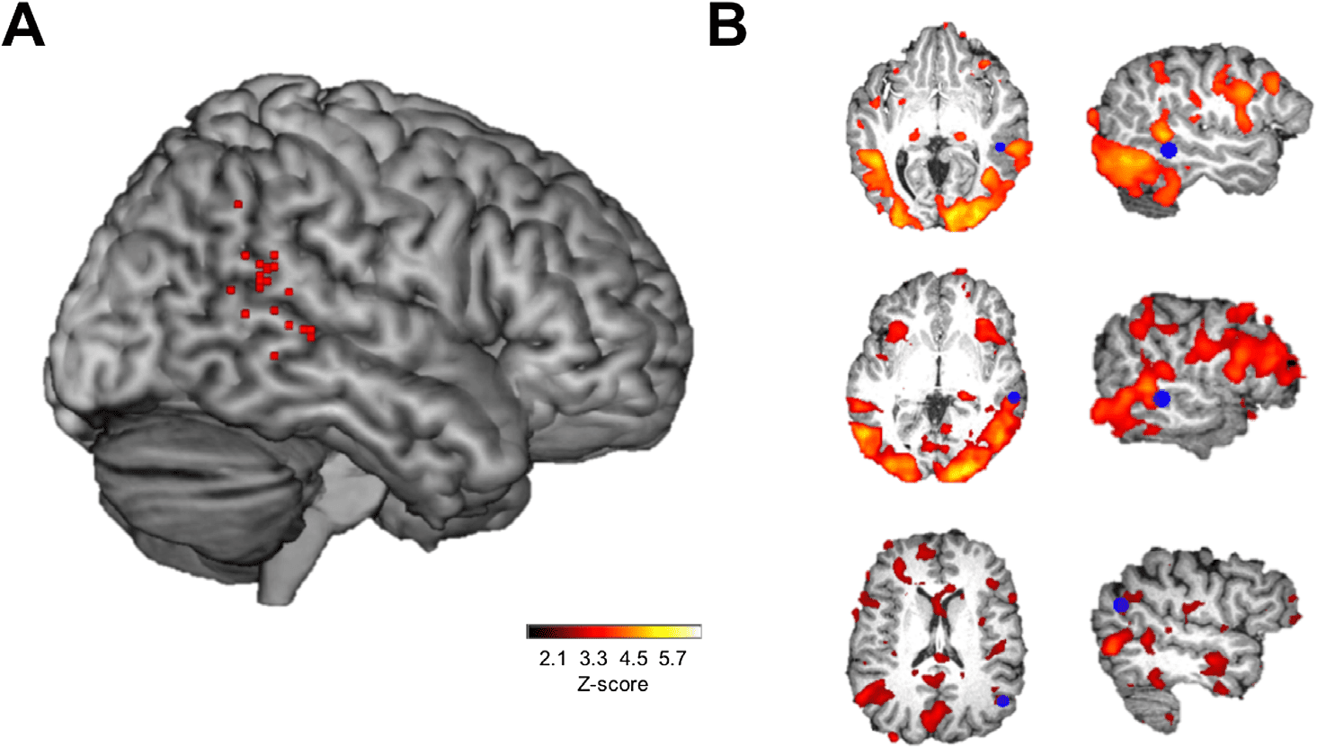 A Causal Role of the Right Superior Temporal image